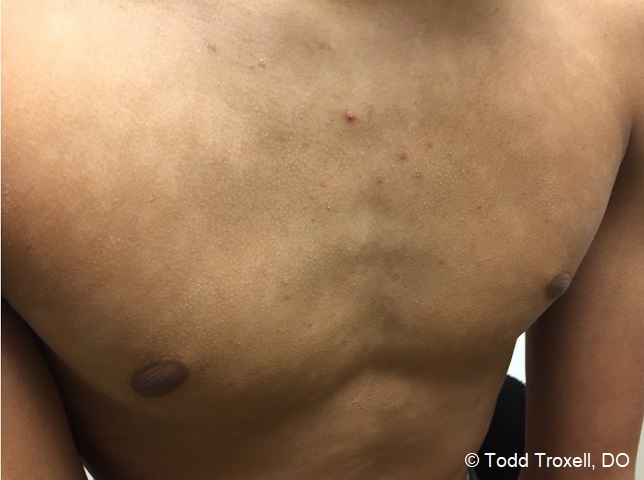 confluent and reticulated papillomatosis vs tinea versicolor)