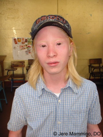 Albinism - American Osteopathic College of Dermatology (AOCD)
