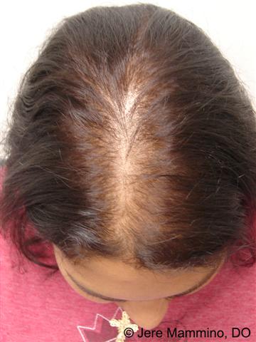 pust Tick Svarende til Female Pattern Hair Loss - American Osteopathic College of Dermatology  (AOCD)