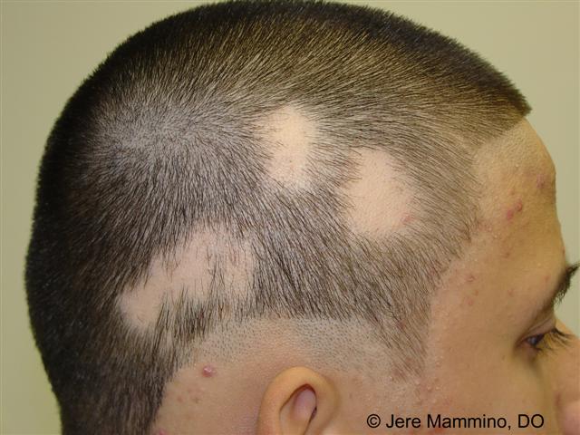 Alopecia Areata - American Osteopathic College of Dermatology (AOCD)