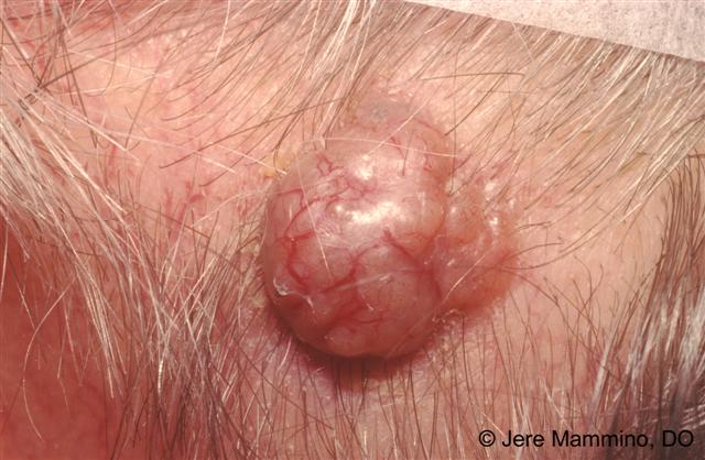 Basal Cell Carcinoma American Osteopathic College Of Dermatology