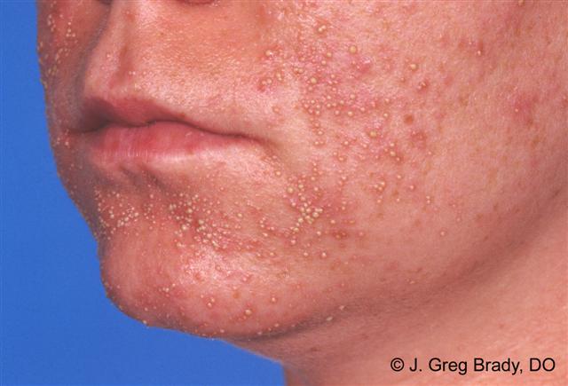 Folliculitis - American Osteopathic College of Dermatology (AOCD)