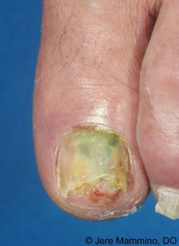 Fungal nail problems - MyDr.com.au