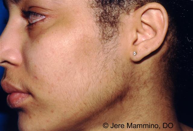 Hirsutism - American Osteopathic College of Dermatology (AOCD)