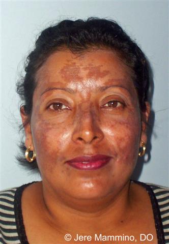 Hyperpigmentation American Osteopathic College Of Dermatology Aocd