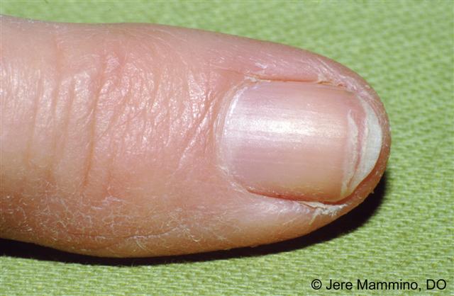 Common Signs of Unhealthy Nails, According to Experts
