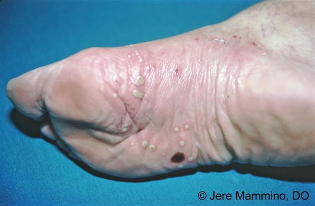 Palmoplantar psoriasis on feet