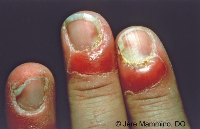 Why do children bite their nails | Blog Pilochka