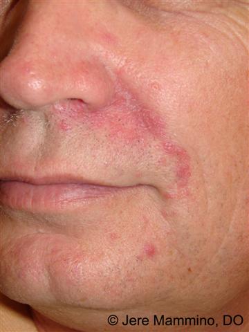 Perioral Dermatitis - American Osteopathic College Dermatology (AOCD)