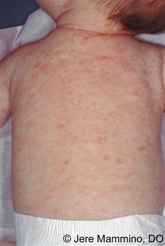Scabies American Osteopathic College Of Dermatology Aocd