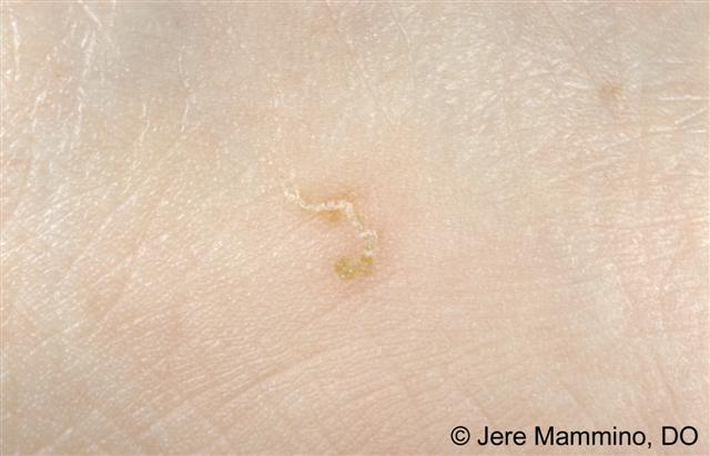 Scabies Rash On Arms