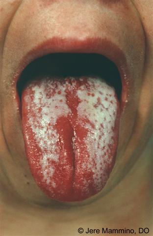 Scarlet Fever - American Osteopathic College of Dermatology (AOCD)