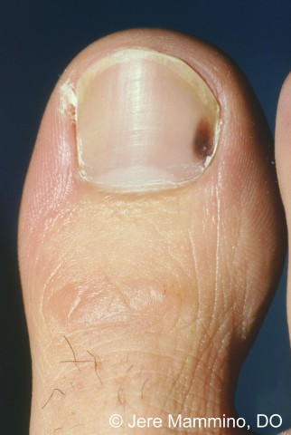 Toe Blood Clot Under Nail Red Stock Photo 1430176517  Shutterstock