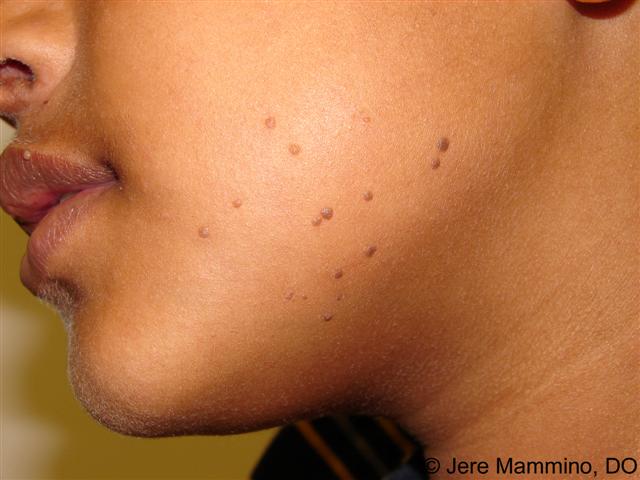 Skin warts on face and neck Wart treatment face